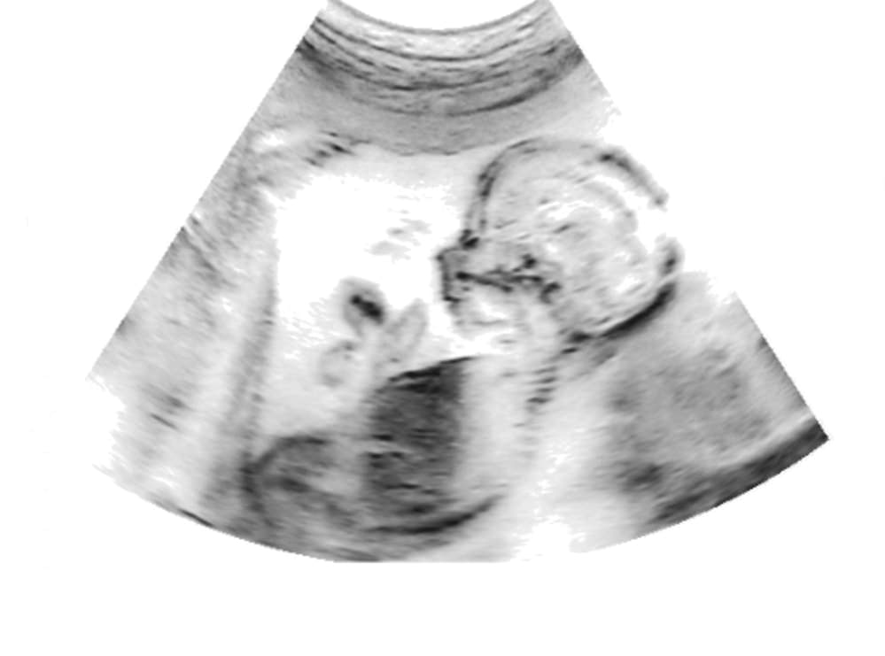 ultrasound scan during pregnancy